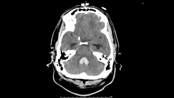 Selective embolization of ruptured feeding artery aneurysm followed by resection of