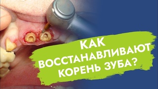 Корень зуба. Наращивание.
