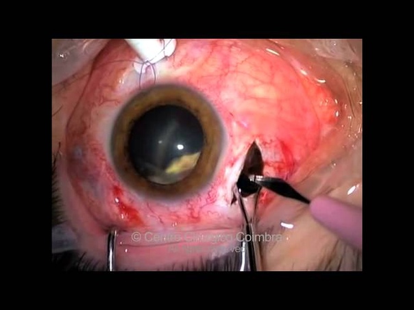 Intraocular Foreign