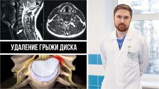 Грыжа шейного отдела позвоночника. Радикулопатия. Как проявляется? Показания и суть операции.