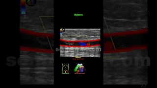 Duplex-Sonographie Thrombose des Bypasses bei peripherer arterieller Verschlusskrankheit-