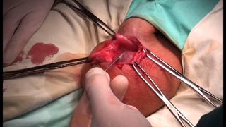 Hydrocele surgery   Операция Бергмана при гидроцеле