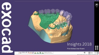 INSIGHTS 2018: Case Demonstration - Telescopic Crowns Part II
