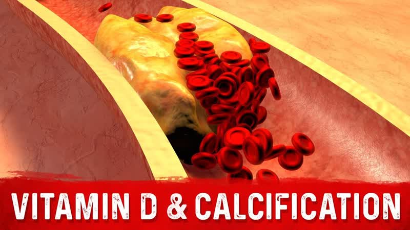 Vitamin D and Coronary Artery Calcification Explained