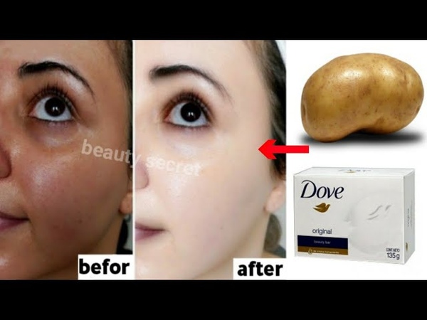 Potatoes and soap, A japanese secret to whitening the skin 10 shades and removing