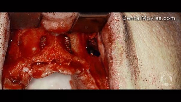 Bilateral sinus lift. 2 anterior implants. Guided bone regeneration with cellulose