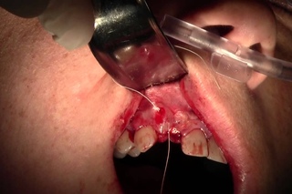 Extraction #7 with Socket Grafting using Cytoplast d-PTFE & Mineross, Full Video