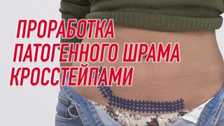 ПРОРАБОТКА ПАТОГЕННОГО ШРАМА КРОССТЕЙПАМИ | Валентин Гайт | Учебный центр BBALANCE