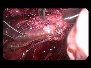 retrocervical