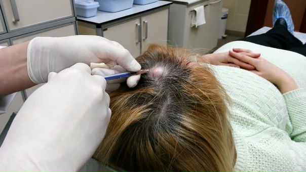 Атерома - это киста (патологическая полость) сальной железы, возникающая в резул